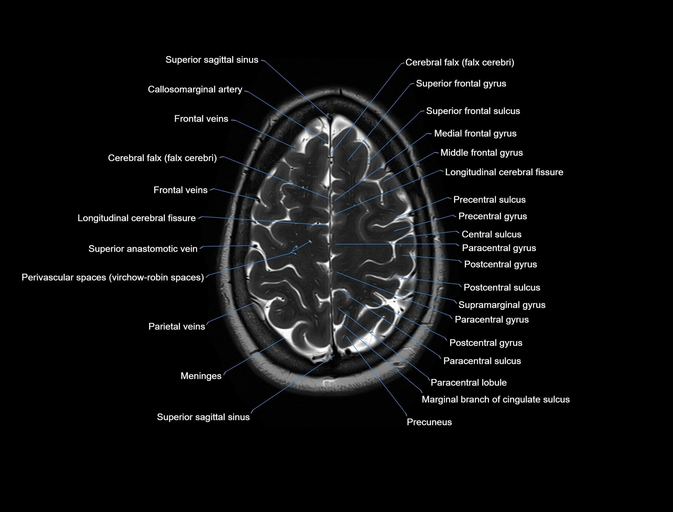 MRI Brain axial cross sectional radiology anatomy 3T image  -img-00001-00048.webp